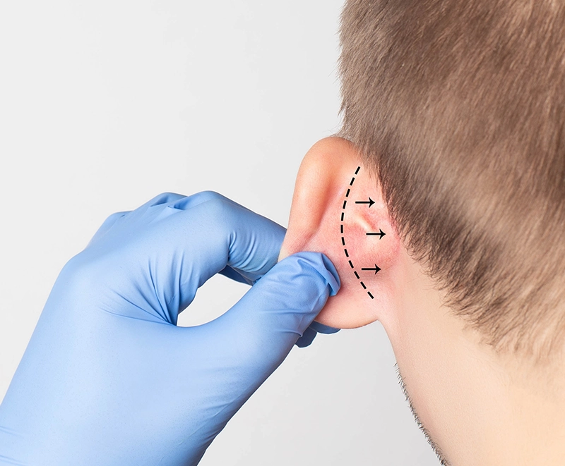 otoplastie
