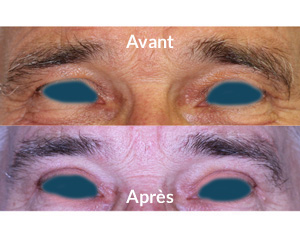 chirurgie-paupiere-sup-et-sourcils-1