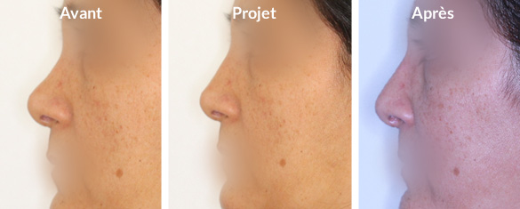 rhinoplastie-augmentation