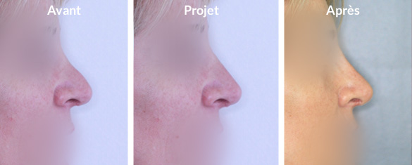 rhinoplastie-augmentation