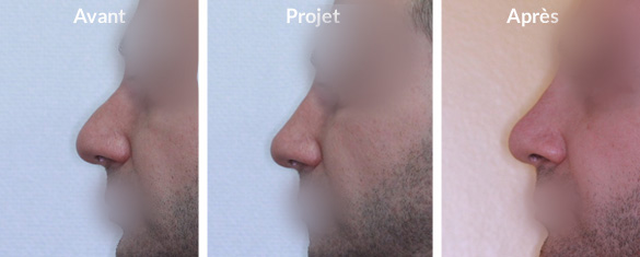 rhinoplastie-augmentation