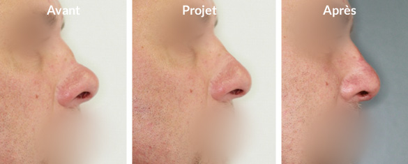 rhinoplastie-augmentation