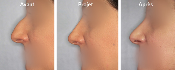 rhinoplastie-bosse2