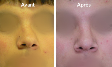 rhinoplastie-nez-devie1