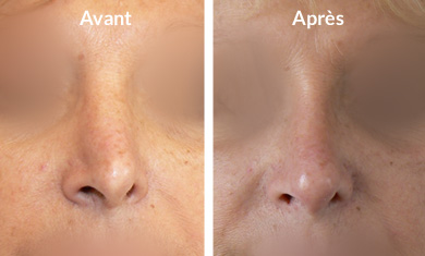 rhinoplastie-nez-devie2