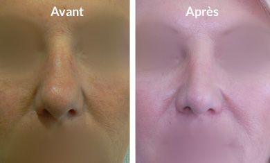 rhinoplastie-pointe-hypertrophique1