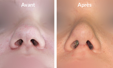 rhinoplastie-pointe-hypertrophique2