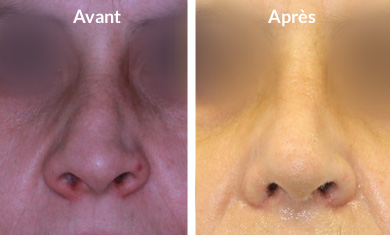 rhinoplastie-pointe-hypertrophique3