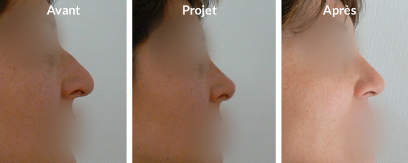 rhinoplastie-pointe-tombante1