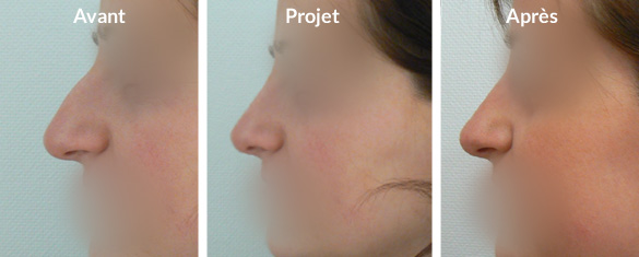 rhinoplastie-pointe-tombante1