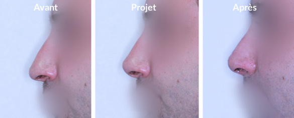 rhinoplastie-pointe-tombante1