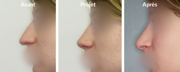 rhinoplastie-pointe-tombante1