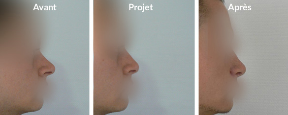 rhinoplastie-recul