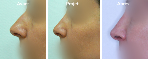 rhinoplastie-recul